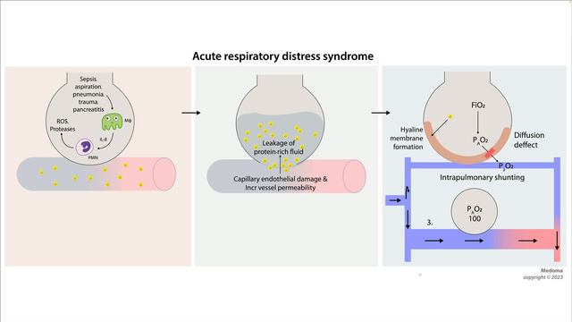 Острый респираторный дистресс синдром - ОРДС: патогенез причины лечение  Медома  USMLE step 1