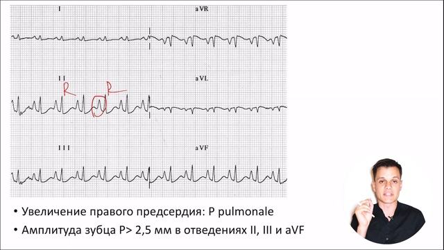 ЭКГ за 100 минут №6: Гипертрофия сердца на ЭКГ смотреть онлайн