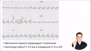 ЭКГ за 100 минут №6: Гипертрофия сердца на ЭКГ