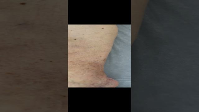 Тромбоз из-за неправильной тактики лечения пациента. Сосудистый хирург. Флеболог Москва смотреть онлайн