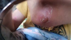 Фурункул дома. Мой опыт