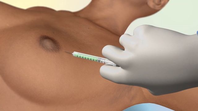 Breast Cancer Surgery: How Fluorescence Guided Surgery Can Reduce Complications смотреть онлайн