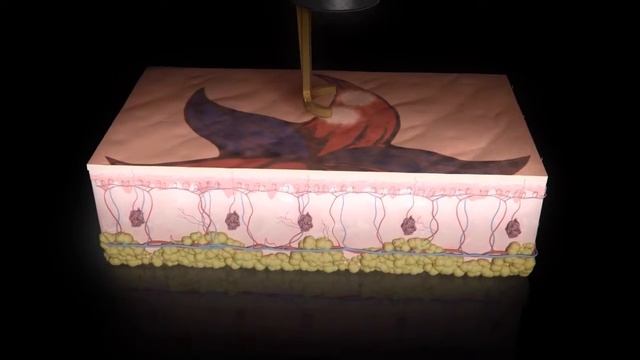 Новый пикосекундный лазер PicoWay, Candela