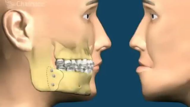 Исправление прикуса смотреть онлайн