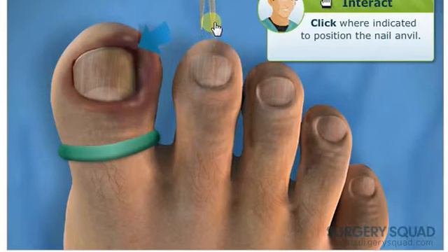 ▶ Симулятор удаления вросшего ногтя (Ingrown Toenail Surgery)
