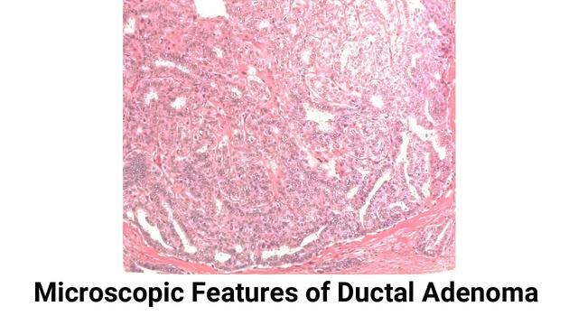 Adenomas of Breast & Fibroepithelial Tumors of Breast смотреть онлайн
