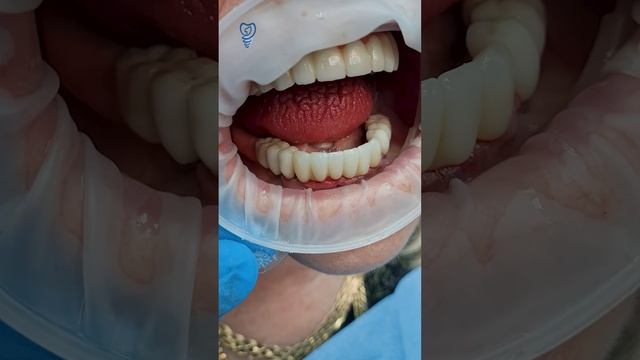 Как звучат новые зубы. Вся челюсть на имплантатах. Имплантация зубов. смотреть онлайн