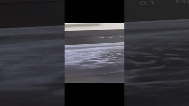 Идеальные вены при повышенном весе. Флеболог Москва смотреть онлайн