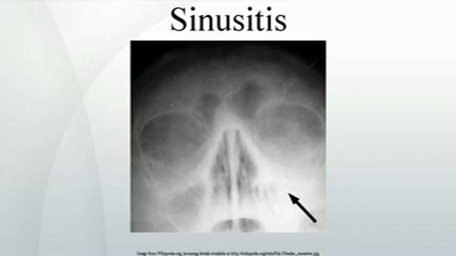 Sinusitis