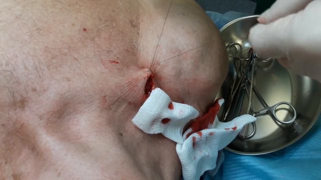 Удаление кератоакантомы смотреть онлайн