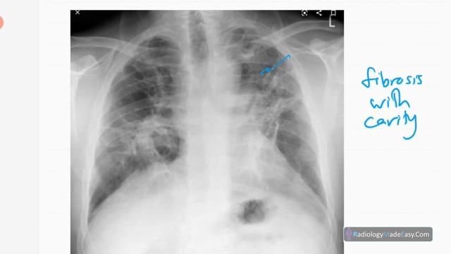 Radiological features of TUBERCULOSIS смотреть онлайн