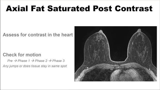 Two Minute Techniques - How to Read a Breast MRI смотреть онлайн