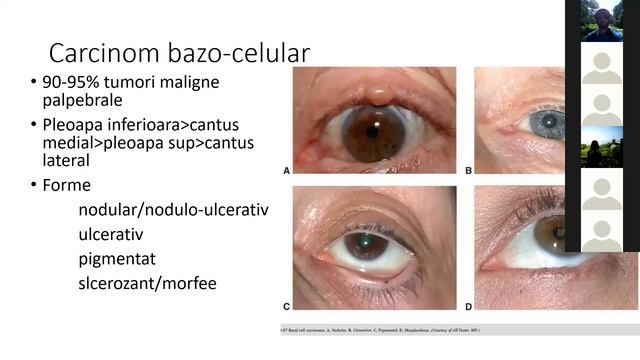 Oculoplastics part 2 Yanoff Workshop смотреть онлайн