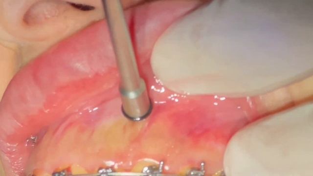 Gummy smile correction by mini implants, upper teeth lifting, gummysmile treatment without surgery смотреть онлайн