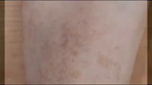 Пигментные пятна (на коже, теле)