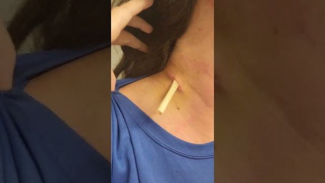Day after excisional biopsy of left cervical lymphnodes смотреть онлайн