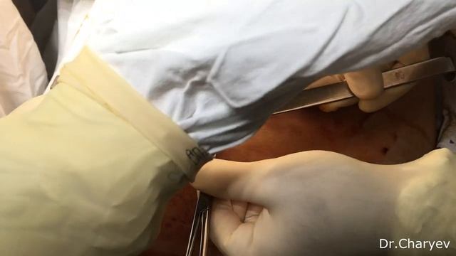 Хирургия для чайников. Лапароскопия. Первые шаги... смотреть онлайн