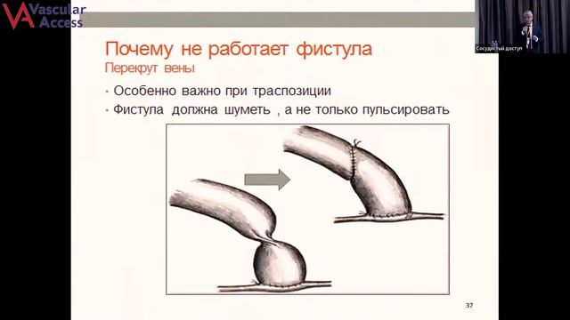 Трансляция семинара : "Сосудистый доступ", г. Нижний Новгород , 5.02.2022 смотреть онлайн