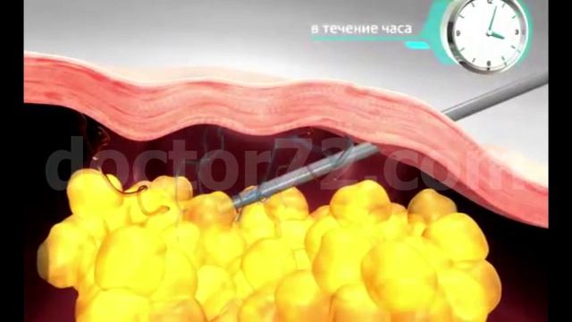 Лазерная липосакция в Тюмени смотреть онлайн