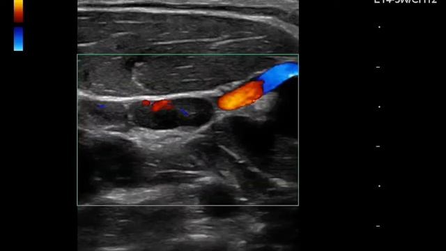 Ultrasound Clip: Normal Lymph Node смотреть онлайн