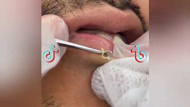 Top best Pimple popping TikTok Videos Compilation #2 смотреть онлайн