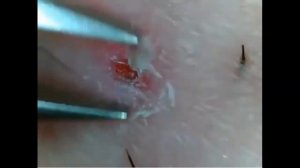 Удаление вросших волос