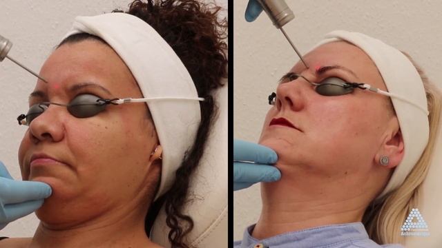 PicoStar® - Peeling par le Dr Bayer 2020 смотреть онлайн