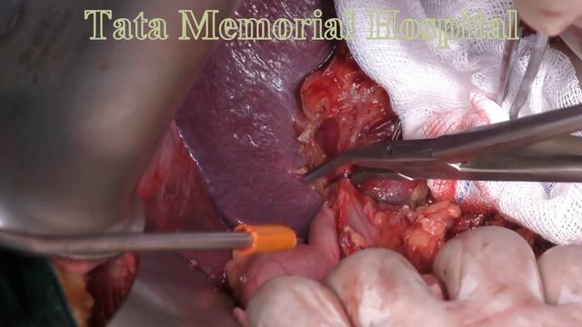 Total Gastrectomy with D2 dissection смотреть онлайн