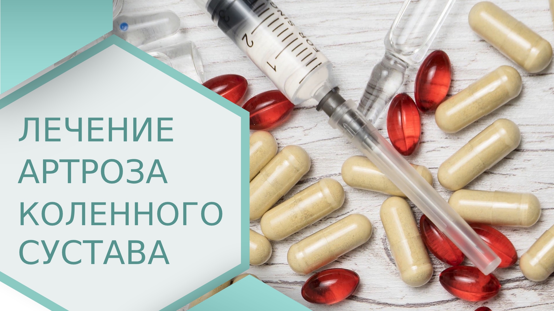 ? Советы врача: как лечить артроз коленного сустава. Как лечить артроз коленного сустава видео. 18+
