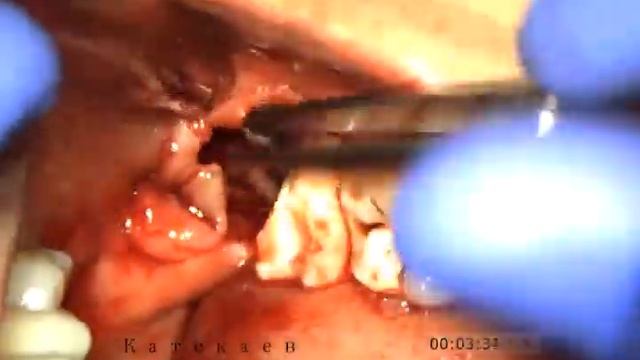 удаление зуба мудрости с разрезом и швами смотреть онлайн