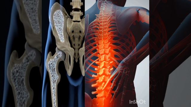 Osteoporoza-Recept Za Prevenciju I Lečenje@ZdravUmTeloDusa