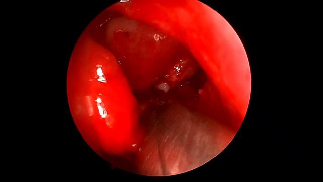 Эндоскопическая гайморотомия. Кистозный гайморит. смотреть онлайн