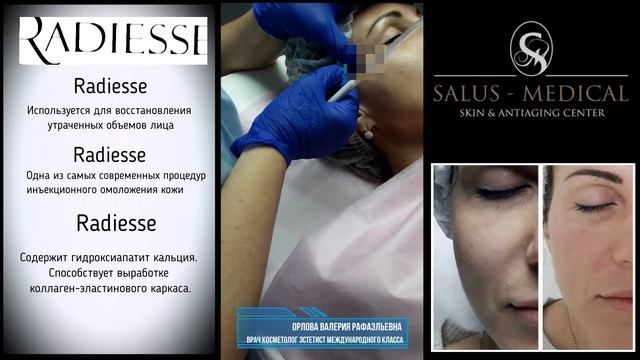 Radiesse. Радиес. Коррекция скул.