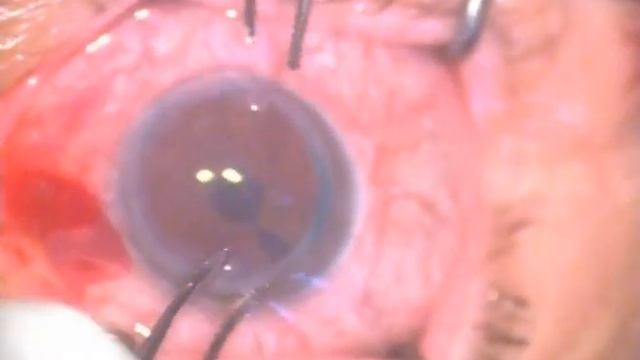 Кератопластика