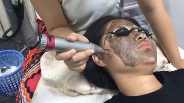 делать карбонового пилинга