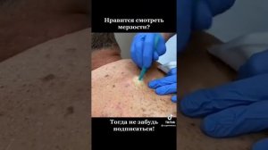 Выдавливание огромных прыщей