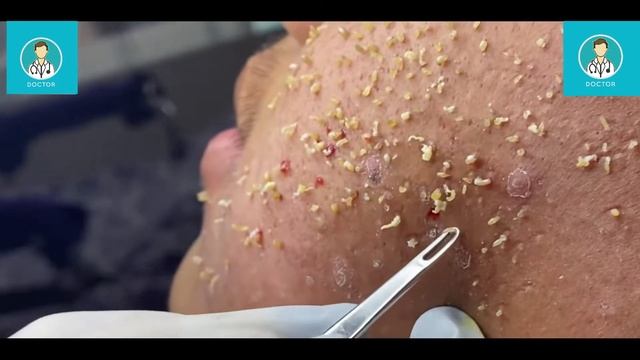 Doctor face Acne clear смотреть онлайн