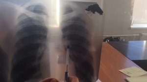 Рентгенограмма легких