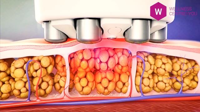 Как избавиться от целлюлита? - Venus Legacy смотреть онлайн