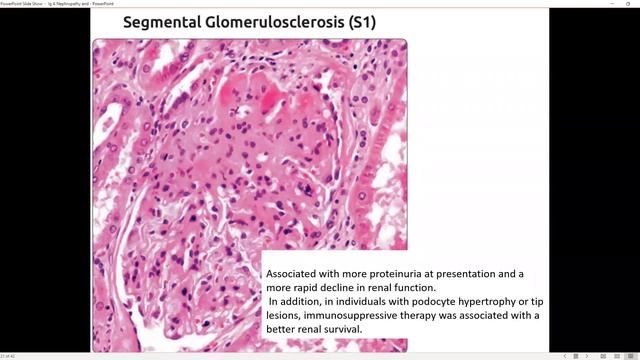 Basics of Renal Pathology : IgA Nephropathy смотреть онлайн