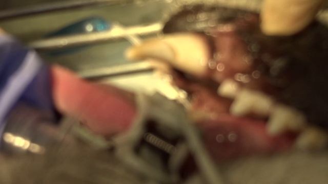 Зуб Шаньдиен начало удаления смотреть онлайн