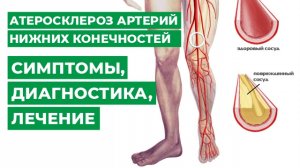 Атеросклероз артерий нижних конечностей, симптомы, диагностика, лечение.