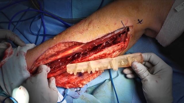 Fibular free flap смотреть онлайн