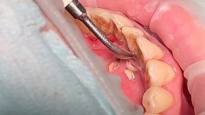 Удаление зубного камня, чистка зубов ультразвуком / Dental plaque