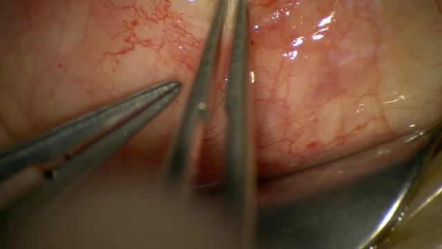 PreserFlo MicroShunt Implantation смотреть онлайн