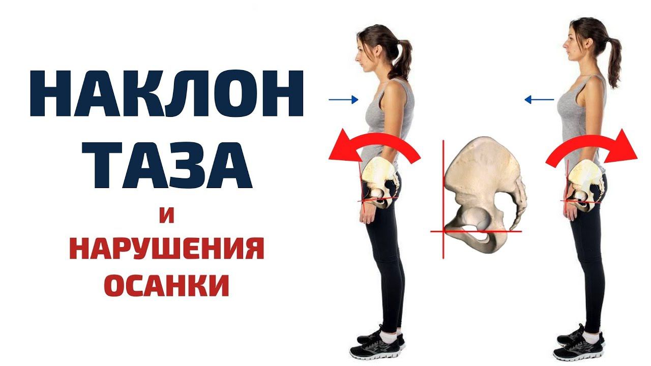 НАКЛОН ТАЗА, ЛОРДОЗ и КИФОЗ ● Какие мышцы укреплять, а какие - растягивать