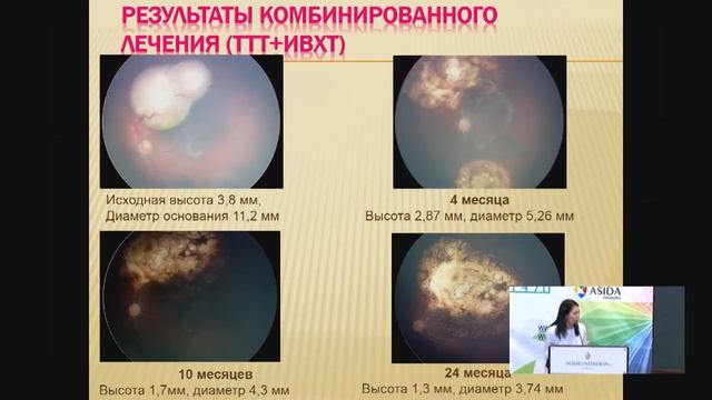 [Онкология] Аубакирова А.С. Первые результаты органосохранного лечения ретинобластомы в Казахстане смотреть онлайн