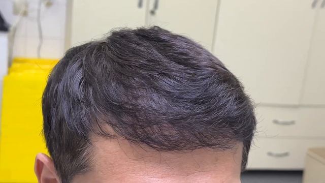 До/После пересадка волос || город Алматы смотреть онлайн