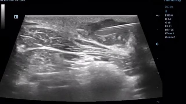 USG GUIDED FNAC OF CERVICAL LYMPH NODE II TB VS SUPPURATIVE LYMPHADENITIS. смотреть онлайн