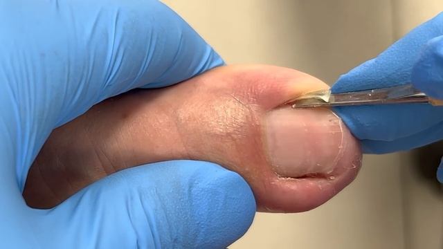 Perfectly Trim Long Toenails And Give It A Good Shape【Xue Yidao】